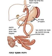 ניתוח-מעקף-קיבה-יתרונות-וחסרונות