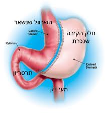 ניתוח-שרוול-קיבה